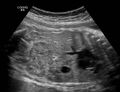 Crossed renal ectopia