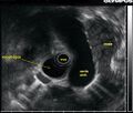 LUL mass radial EUS