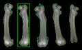 Bone density measurement