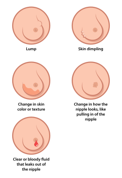 Breast cancer illustration