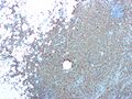 Xanthogranulomatous pyelonephritis with CD68 staining