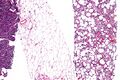 Dedifferentiated liposarcoma - intermediate magnification