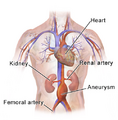 Abdominal Aortic Aneurysm Location