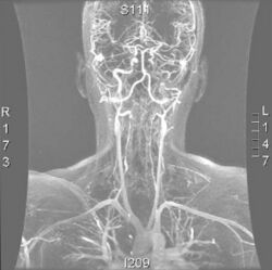 Vertebral Artery Dissection MRI