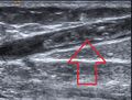 Great saphenous vein thrombosis