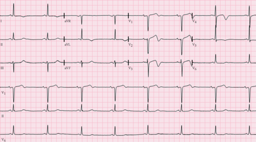 Wellens'_Syndrome