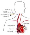 Pulmonary artery catheter diagram in English