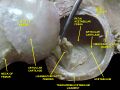 Femoral head