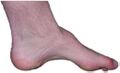 Foot affected by Charcot–Marie–Tooth disease