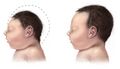 Comparison showing microcephaly