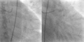 Left anterior descending artery