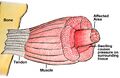 Compartment Syndrome in Muscle (cleaned up)