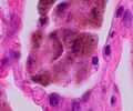Histopathology of smoker's macrophages with anthracotic stippling