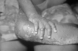 Monkeypox lesions on a hand