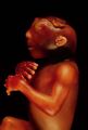 Anencephaly condition
