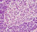 Islet cell transplantation
