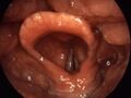 Larynx normal