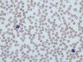 Iron deficiency anemia