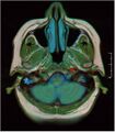 Brain MRI 0106 17