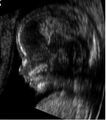 Embryo at 14 weeks profile