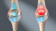 3D still showing Bursitis