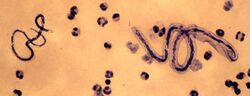Filariasis Microfilariae of Loa loa