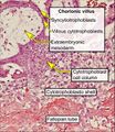 Histopathology of tubal pregnancy