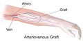 Arteriovenous graft