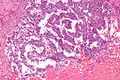 List of vaginal tumors