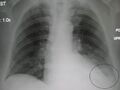 Left lower lobe pneumonia with effusion