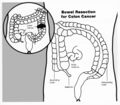 Bowel resection illustration