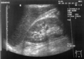 Hepatorenal recess