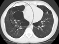 Mediastinal shift