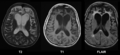 Cerebral atrophy