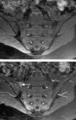 Sacroiliitis MRI