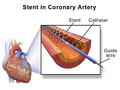 Angioplasty Stent